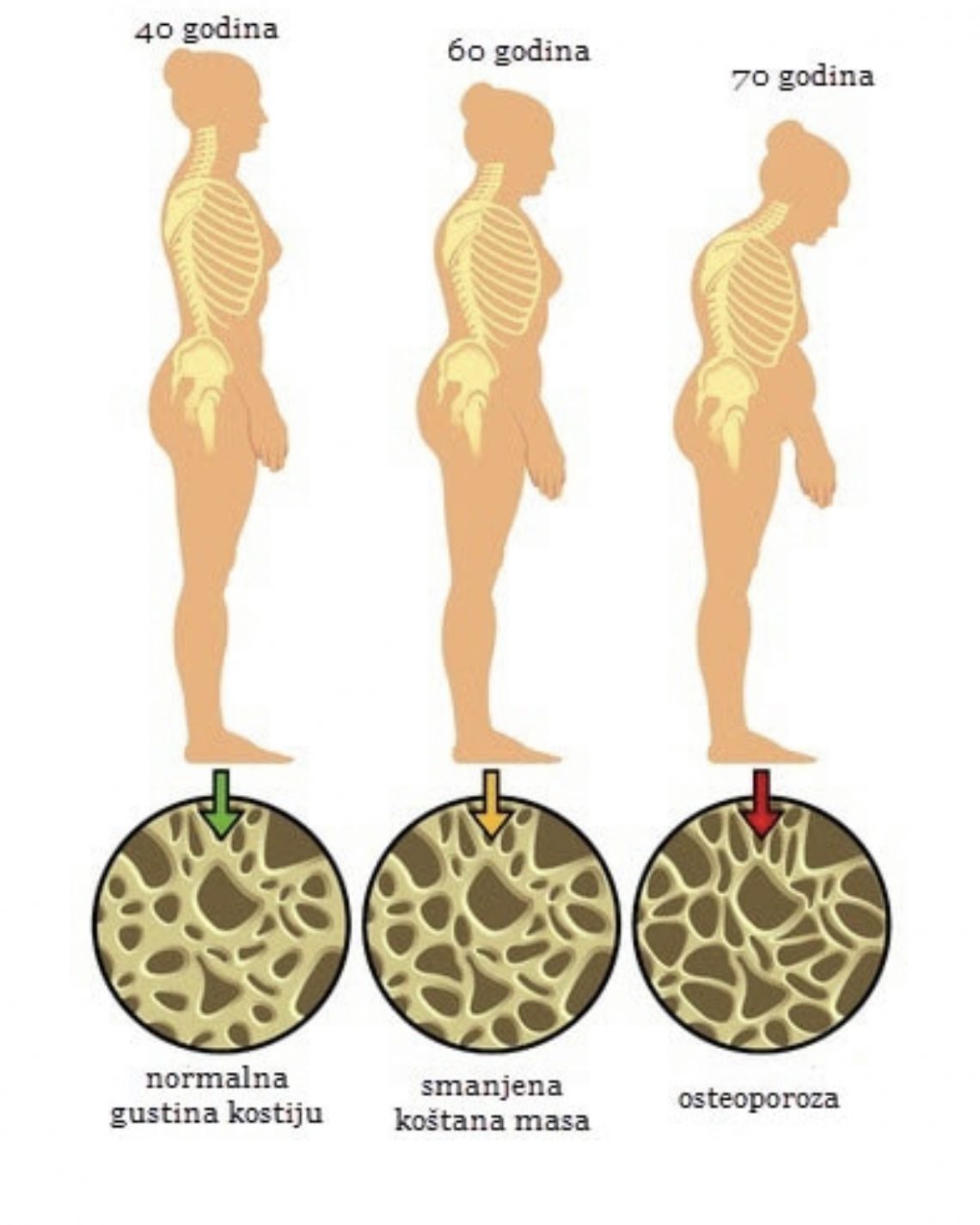 Svjetski dan osteoporoze – 20. oktobar