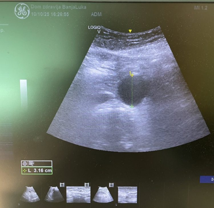 Spašeni životi zahvaljujući preventivnim pregledima – mjesec dana skrininga aneurizme abdominalne aorte