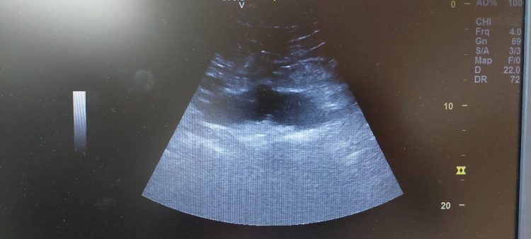 Nastavljamo dalje sa ranim otkrivanjem aneurizme abdominalne aorte – do sada spašeno 12 života