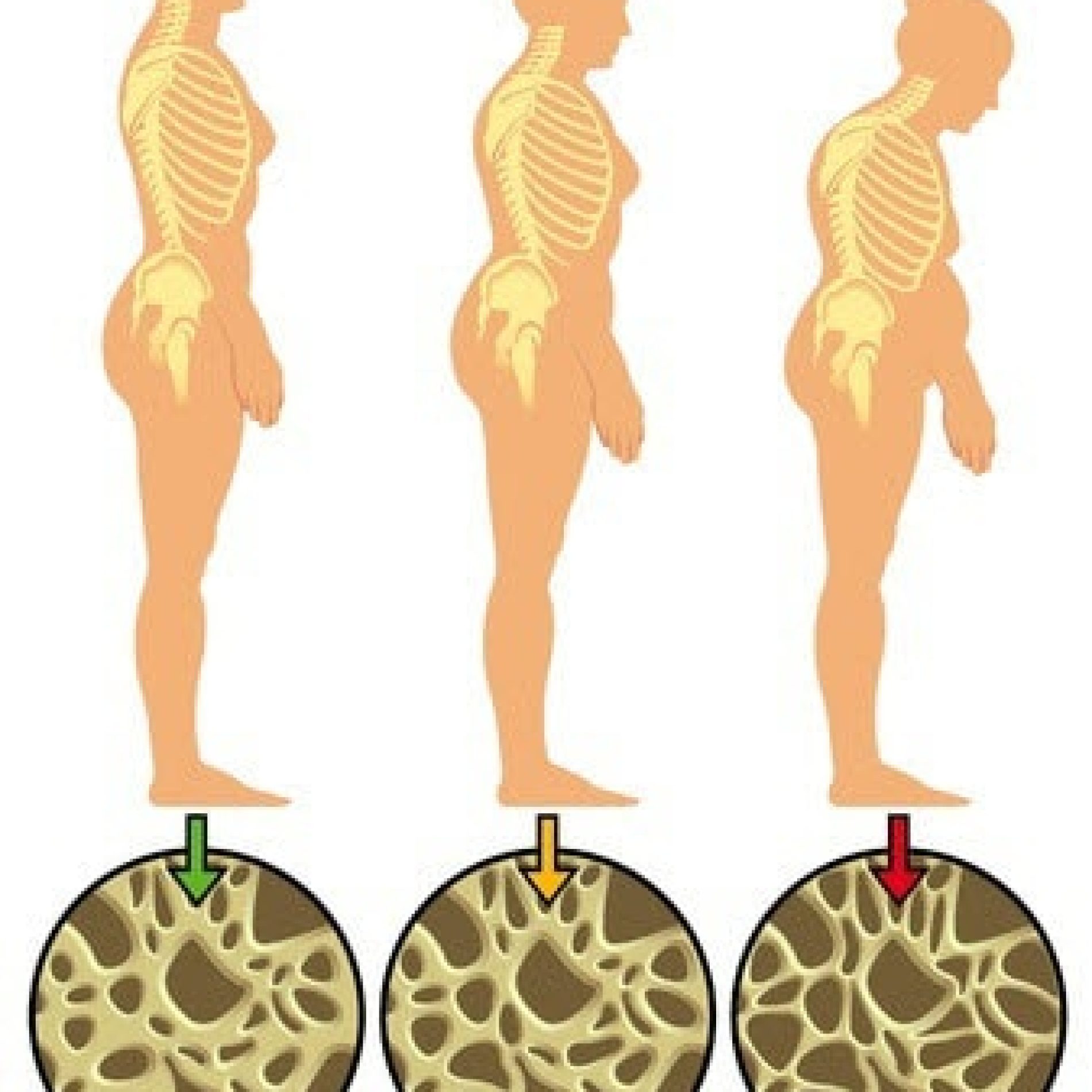 osteoporoza_kostiju